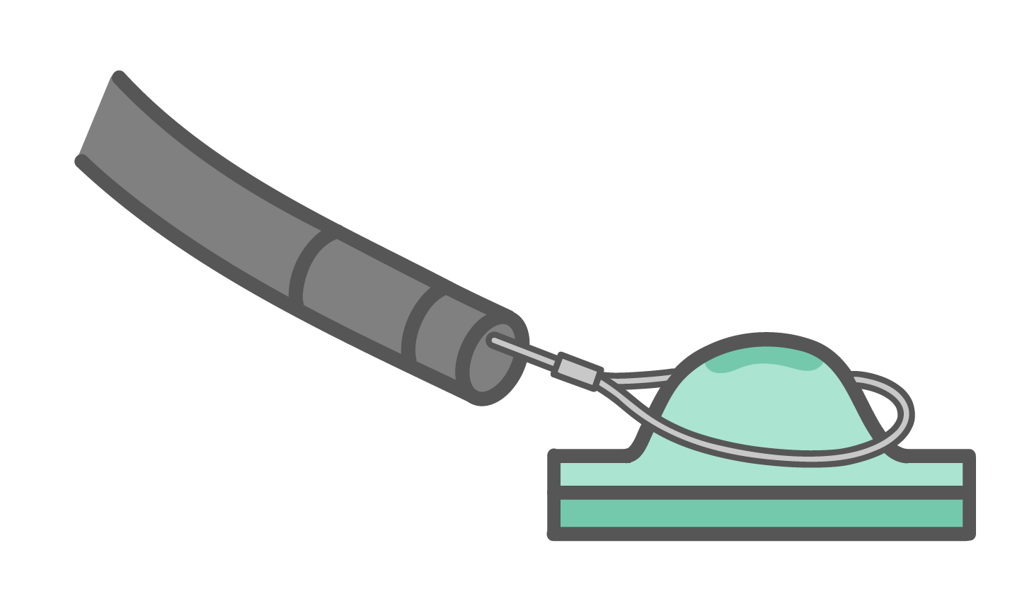 生理食塩水の注入（局注）によってドーム状に盛り上がった粘膜（病変）の根元に、内視鏡から出したスネア（金属の輪）をかけている断面図イラスト。