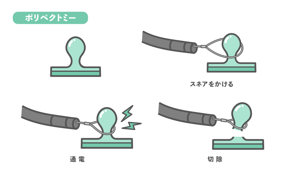 内視鏡的ポリープ切除術（ポリペクトミー）の4段階の手順図。1.ポリープ確認、2.スネア（金属の輪）をかける、3.通電して焼き切る、4.切除完了の流れ。