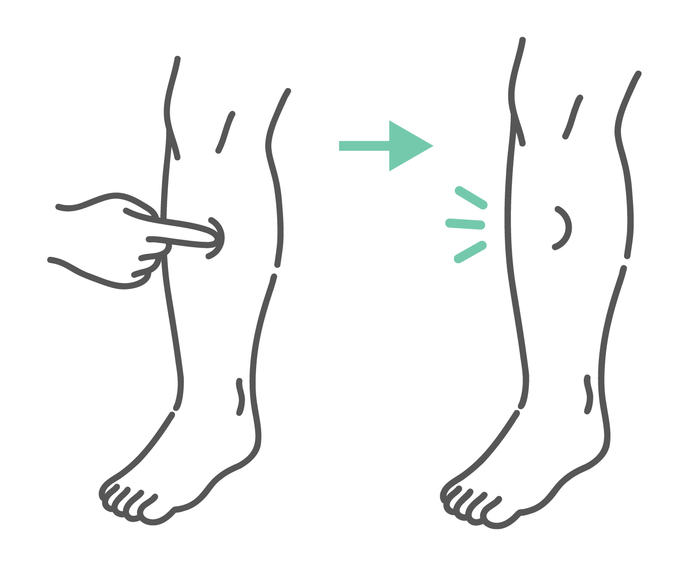 足のすねを指で押している様子と、指を離した後にくっきりとしたへこみが残っている様子を示したむくみのセルフチェック図解